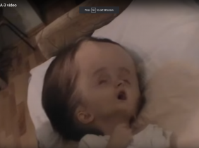 Maria was diagnosed with hydrocephalus